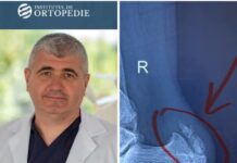 Pintenul de la călcâi – cum scapi de durere?